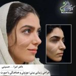 آشنایی با عمل جراحی زیبایی بینی- دکتر امراله حسینی -doctor-hosseini.com