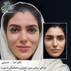 آشنایی با عمل زیبایی بینی- دکتر امرالله حسینی - doctor-hosseini.com