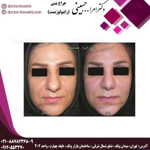 جراحی بینی های گوشتی