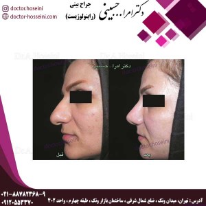 جراحی بینی های گوشتی