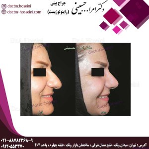 جراحی بینی های گوشتی