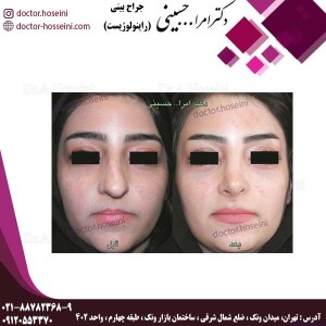 جراحی در بینی های کج - دکتر حسینی - doctor-hosseini.com
