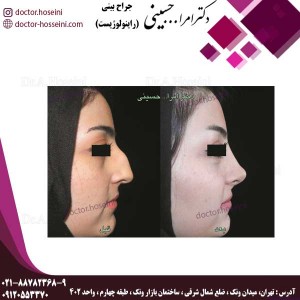 جراحی در بینی های کج - دکتر امرالله حسینی -doctor-hosseini.com