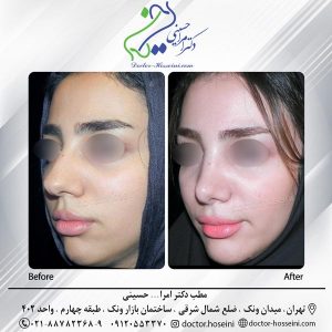 عمل زیبایی چانه- دکتر حسینی -doctor-hosseini.com