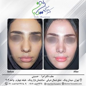 عکس جراحی زیبایی چانه- دکتر حسینی - doctor-hosseini.com