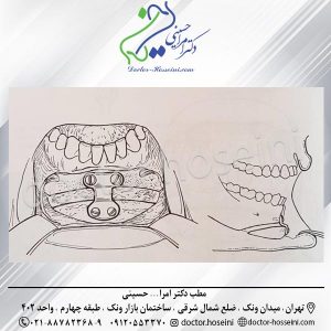 جراحی زیبایی چانه- دکتر امراله حسینی - doctor-hosseini.com