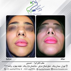 عکس عمل پروتز چانه - دکتر حسینی - doctor-hosseini.com