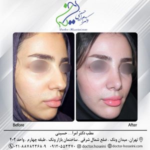 جراحی زیبایی چانه- دکتر امرالهل حسینی - doctor-hosseini.com