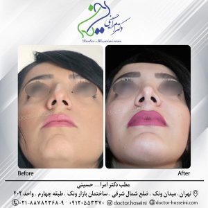 جراحی زیبایی چانه