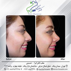 جراحی زیبایی چانه